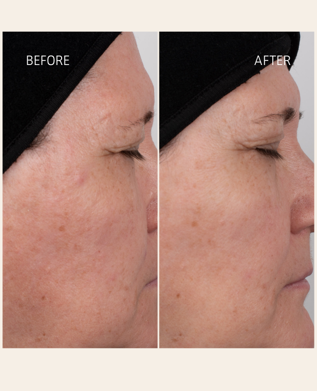 Before and after using FLOREA Serum by Hueliá Botanicals – visible improvement in skin tone, hydration, and smoothness in mature skin after daily use of vitamin C and peptide-rich serum.