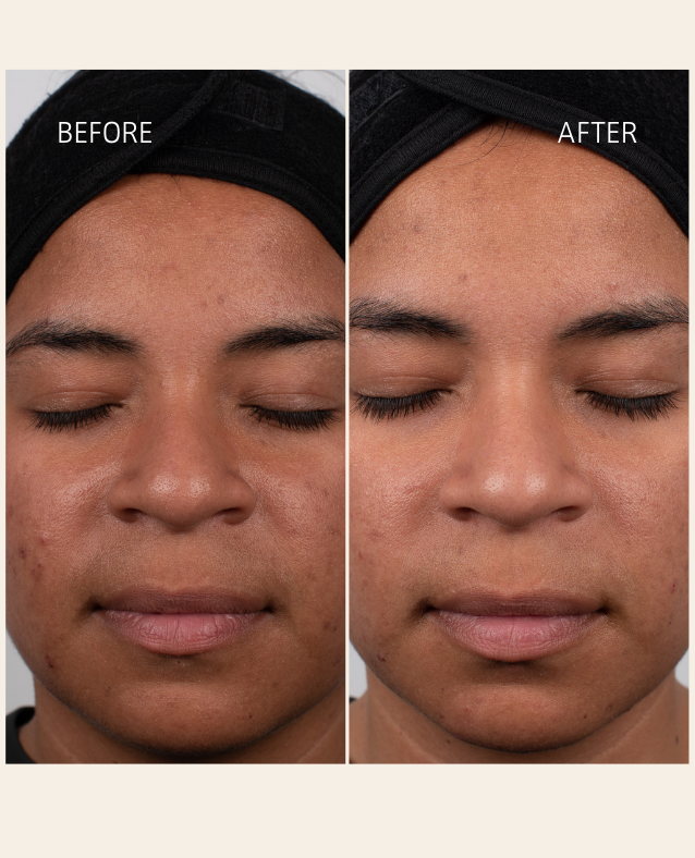 Before and after results using ETEREA Retinol Alternative Oil – smoother skin texture and reduced blemishes on melanin-rich skin