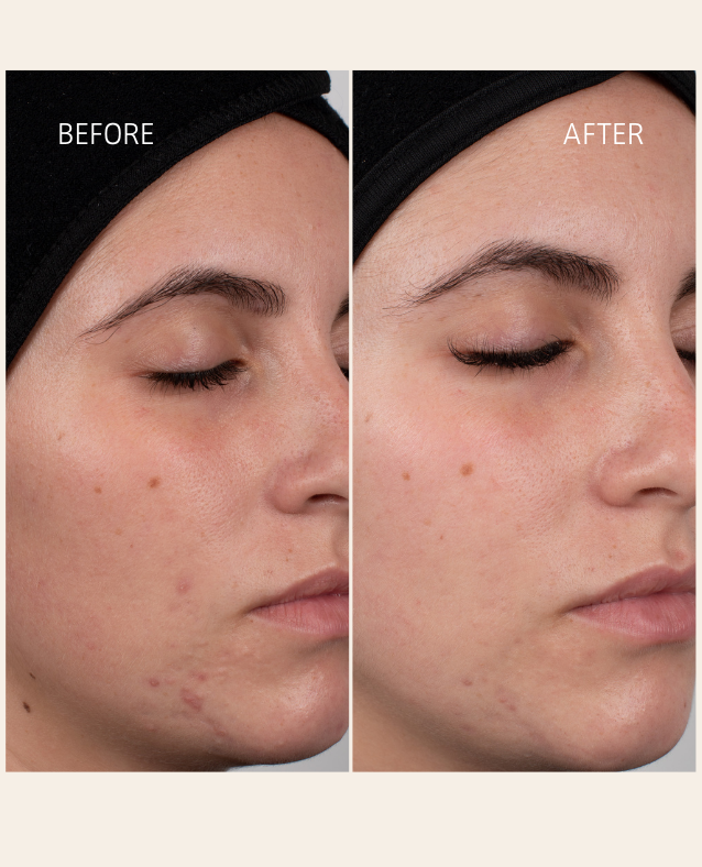 Visible skin transformation with ETEREA Face Oil – improved clarity, glow, and skin tone with gentle botanical retinol alternative